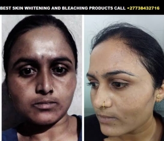 Skin Bleaching and whitening in Mali +27738432716