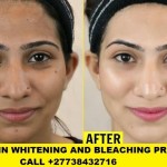 Skin Bleaching and whitening in Senagal +27738432716